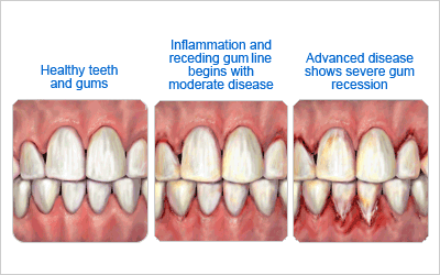 Gum Disease Pics