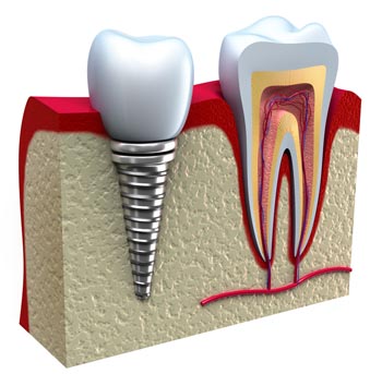 dental implants