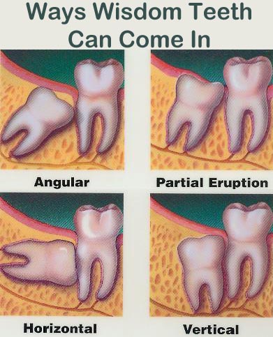 wisdom teeth tooth dental eruption pain extraction why gum hurt coming swollen molars hurts should gums removal dentist eat location