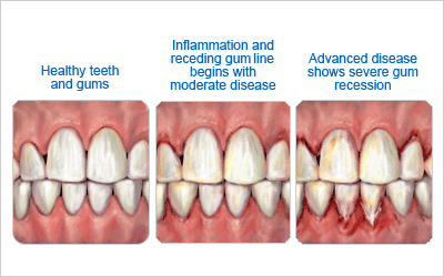 Gum Disease Comparison