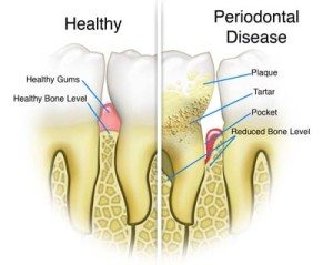 Gum Disease, Periodontal disease