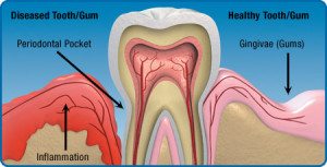 Gum Disease - Comfort Dental of Lafayette