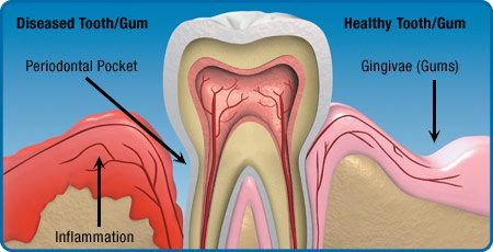 gum disease, periodontal disease