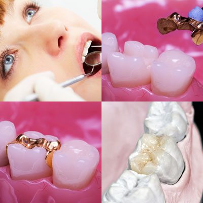 Dental inlay, dental onlay