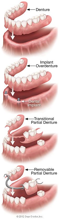 Denture types