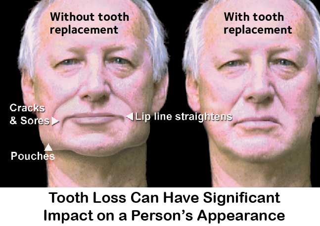 Face with Tooth Loss