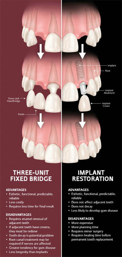 Dental implants vs dental bridge