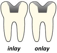 Crown Alternative, Dental inlay and dental onlay