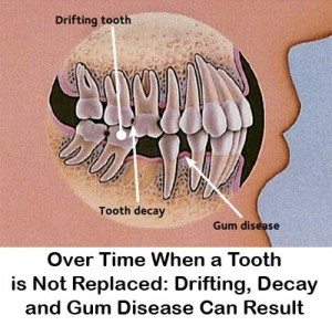 Tooth loss not replaced
