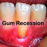 gum recession, chewing tobacco risks