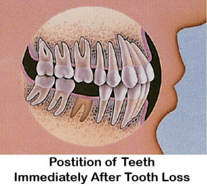 Tooth Loss before image