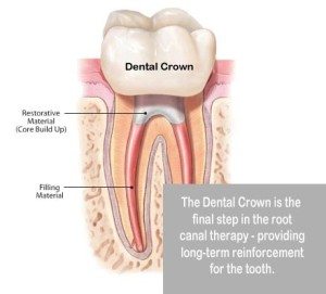Crown and Root Canal