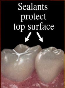Dental sealants protect teeth