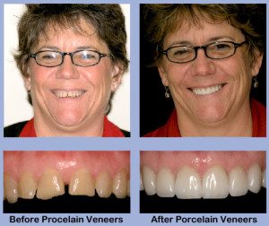 Dental Veneers, Porcelain Veneers