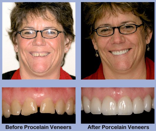 Cosmetic Dentistry Before After Photos, Porcelain Veneers Pictures