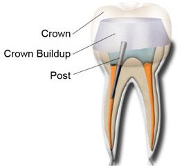 Dental Crown build up