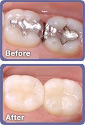 Tooth colored fillings, resin fillings