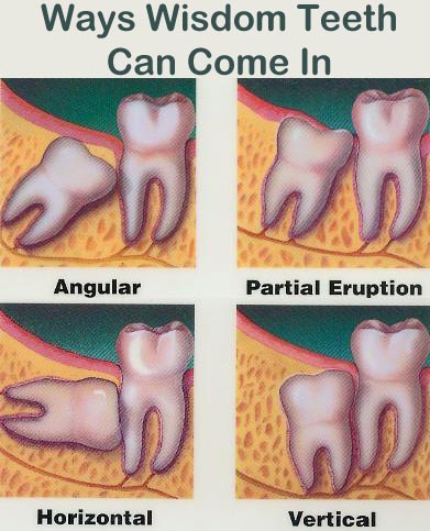 broken wisdom tooth extraction