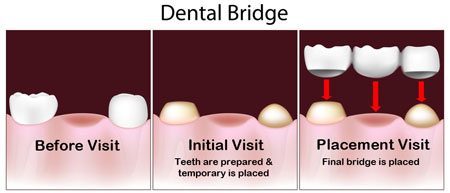 Dental bridge appointments